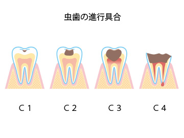 虫歯の進行具合