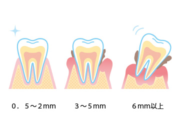 歯周病の進行具合
