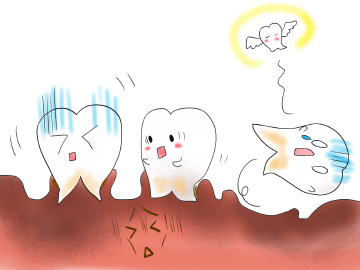 歯周病で歯が抜け落ちる