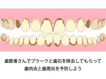 プラークが溜まっている歯
